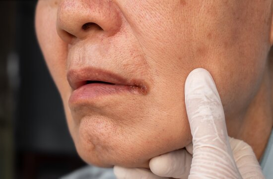 Kanceri i gojës, kokës dhe qafës – Këto janë shenjat e para paralajmëruese që nuk duhet t’i neglizhoni